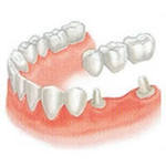 112_protezirovanie_zubov.jpg